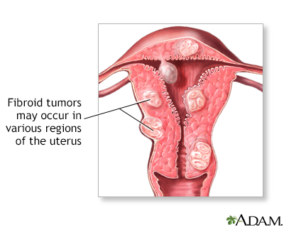 Fibroid